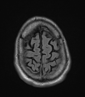File:Alzheimer's disease- with apraxia (Radiopaedia 54763-61011 Axial FLAIR 25).png
