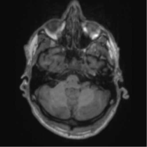 File:Alzheimer's disease- with apraxia (Radiopaedia 54763-61011 Axial T1 17).png