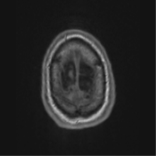 File:Alzheimer's disease- with apraxia (Radiopaedia 54763-61011 Axial T1 72).png