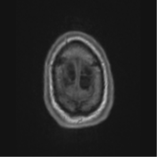 Alzheimer's disease- with apraxia (Radiopaedia 54763-61011 Axial T1 73).png