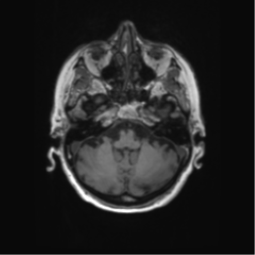 File:Alzheimer's disease (Radiopaedia 42658-45802 Axial T1 119).png
