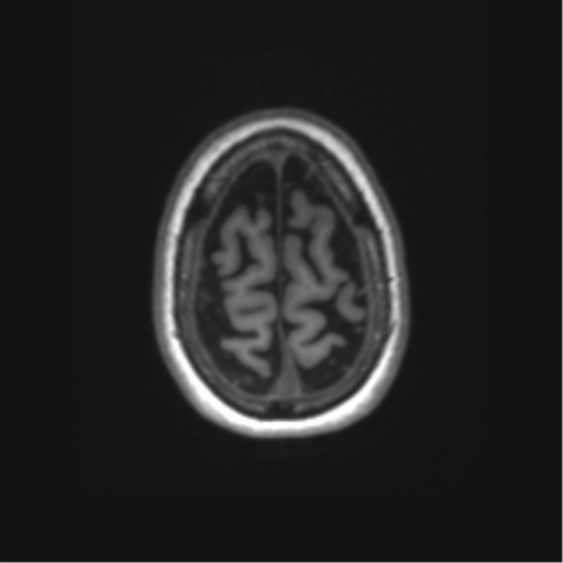 Alzheimer's disease (Radiopaedia 42658-45802 Axial T1 25).png