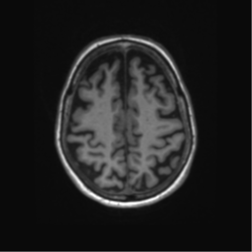 File:Alzheimer's disease (Radiopaedia 42658-45802 Axial T1 44).png