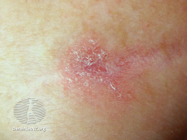 File:Amelanotic melanoma (DermNet NZ amelanotic-melanoma-019).jpg