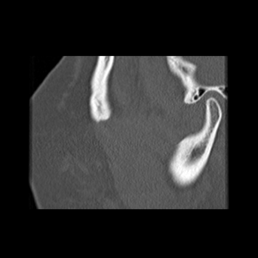 File:Ameloblastic fibro-odontoma (Radiopaedia 18843-18780 bone window 18).jpg