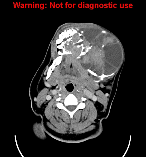 File:Ameloblastoma (Radiopaedia 33126-34164 B 13).jpg