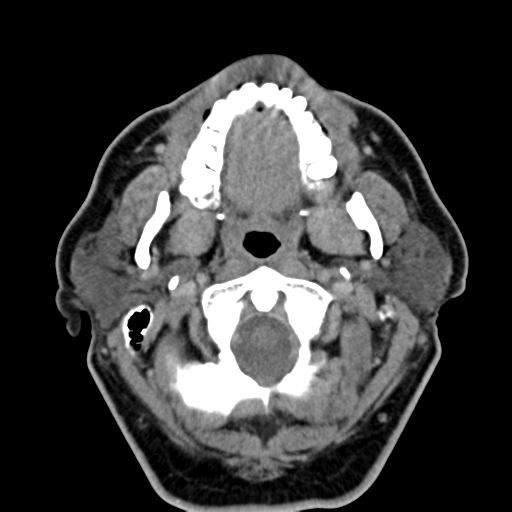 Ameloblastoma (Radiopaedia 38520-40623 Axial non-contrast 23).png