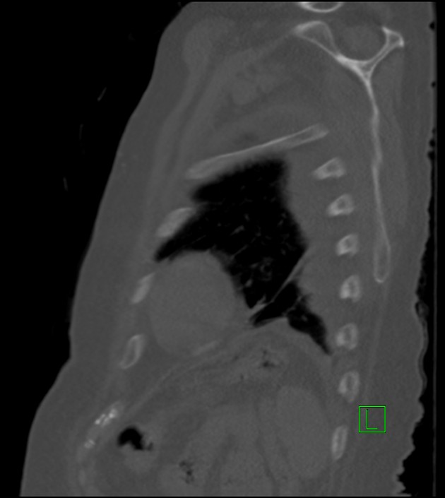 Amiodarone deposition in the liver (Radiopaedia 77587-89780 Sagittal bone window 21).jpg