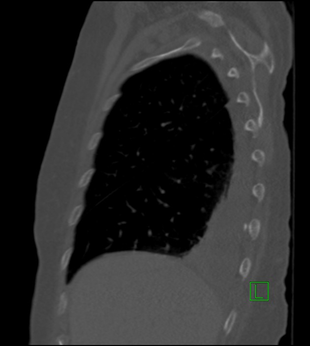 Amiodarone deposition in the liver (Radiopaedia 77587-89780 Sagittal bone window 77).jpg