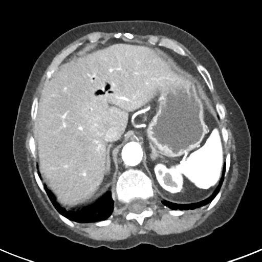 Ampullary adenocarcinoma (Radiopaedia 34013-35237 B 15).png