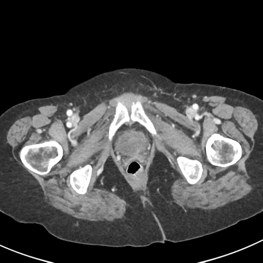 Ampullary adenocarcinoma (Radiopaedia 34013-35237 C 60).png