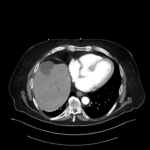 Ampullary adenocarcinoma (Radiopaedia 59373-66734 A 24).jpg