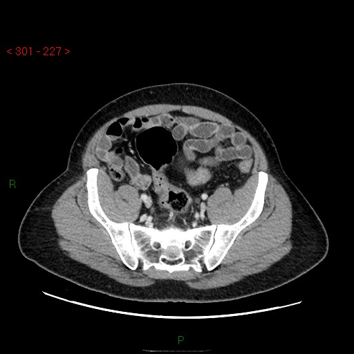 File:Ampullary carcinoma (Radiopaedia 56396-63056 C 79).jpg