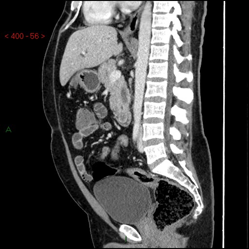 Ampullary carcinoma (Radiopaedia 56396-63056 D 55).jpg