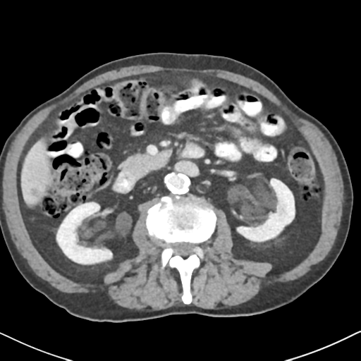 File:Amyand hernia (Radiopaedia 39300-41547 A 29).png