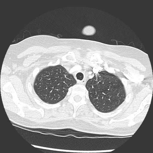 Amyloidosis - bronchial and diffuse nodular pulmonary involvement (Radiopaedia 60156-67745 Axial lung window 10).jpg