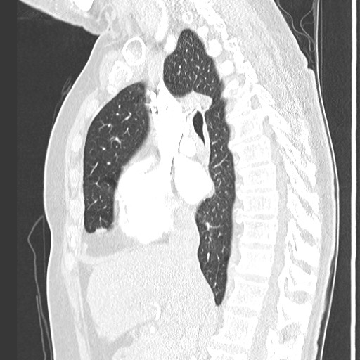 Amyloidosis - bronchial and diffuse nodular pulmonary involvement (Radiopaedia 60156-67745 Sagittal lung window 40).jpg