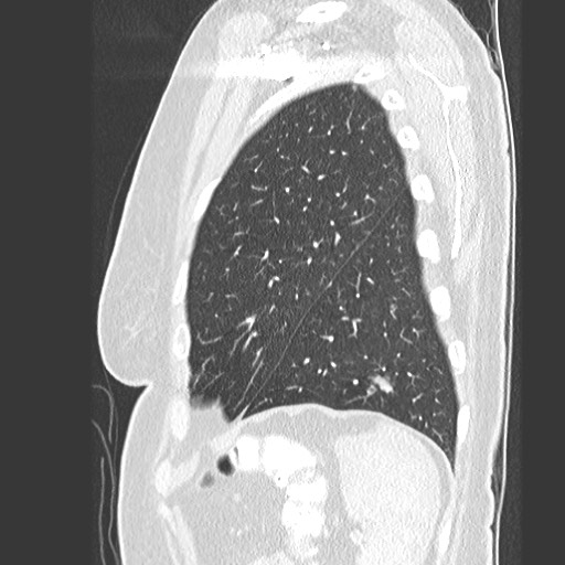 File:Amyloidosis - bronchial and diffuse nodular pulmonary involvement (Radiopaedia 60156-67745 Sagittal lung window 77).jpg