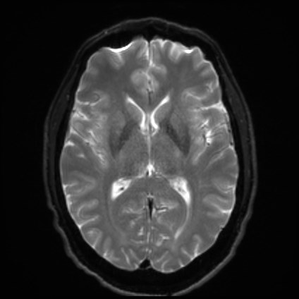 File:Amyotrophic lateral sclerosis (Radiopaedia 87352-103658 Axial DWI 14).jpg