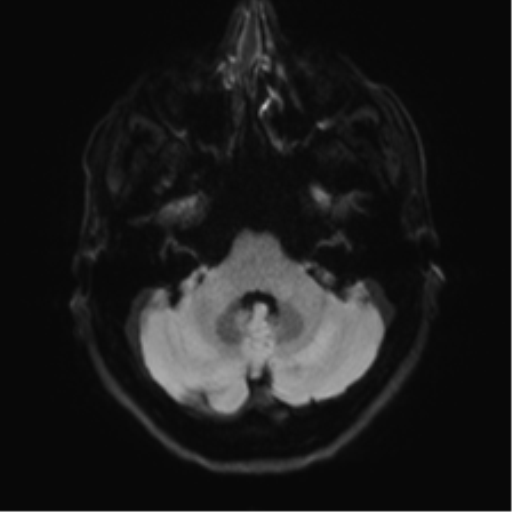 Anaplastic astrocytoma - thalamic glioma (Radiopaedia 59709-67115 Axial DWI 43).png