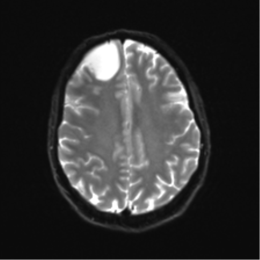 Anaplastic astrocytoma IDH mutant (Radiopaedia 50046-55341 Axial DWI 20).png