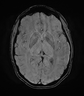 File:Anaplastic astrocytoma IDH mutant (Radiopaedia 50046-55341 Axial SWI 45).png