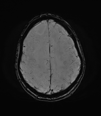 File:Anaplastic astrocytoma IDH mutant (Radiopaedia 50046-55341 Axial SWI 67).png