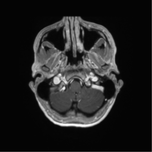 File:Anaplastic astrocytoma IDH mutant (Radiopaedia 50046-55341 Axial T1 C+ 8).png