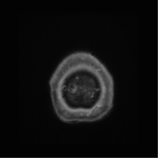 Anaplastic astrocytoma IDH wild-type (pseudoprogression) (Radiopaedia 42209-45277 Axial T1 C+ 130).png