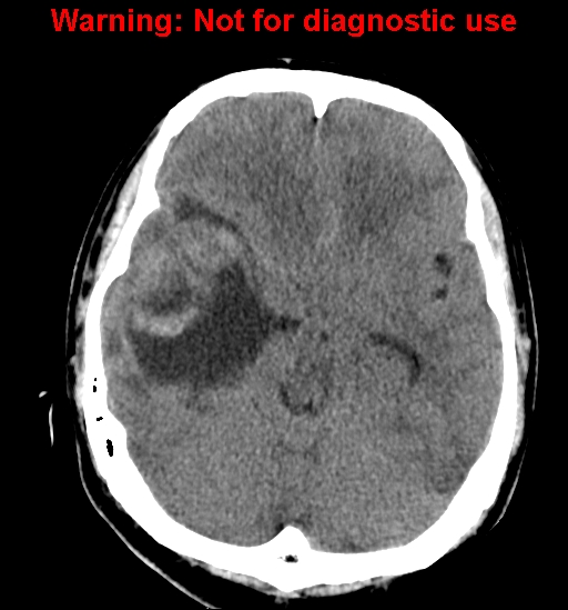 File:Anaplastic ganglioglioma (Radiopaedia 44921-48815 Axial non-contrast 10).jpg