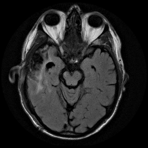 File:Anaplastic meningioma with recurrence (Radiopaedia 34452-35791 Axial FLAIR 8).png