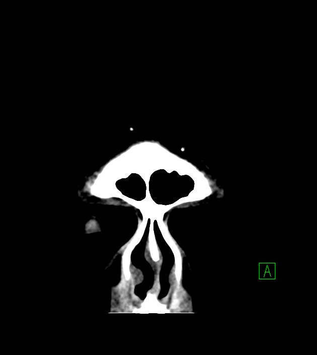 Anaplastic oligodendroglioma (Radiopaedia 79571-92758 Coronal non-contrast 7).jpg