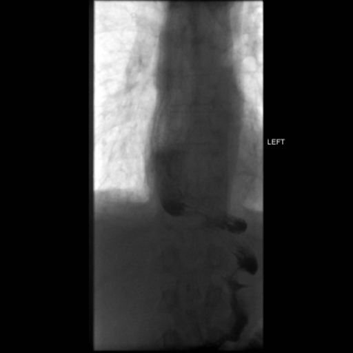 File:Anastomotic stricture post Ivor Lewis esophagectomy (Radiopaedia 47937-52715 C 21).png