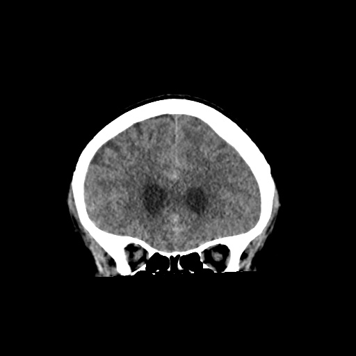 Aneursym related subarachnoid hemorrhage with hydrocephalus (Radiopaedia 45105-49083 Coronal non-contrast 18).jpg
