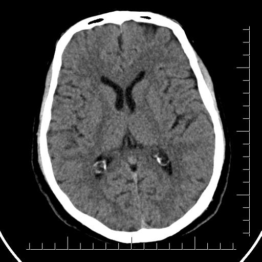 File:Aneurysm of posterior communicating artery (Radiopaedia 20188-20162 Axial non-contrast 26).jpg