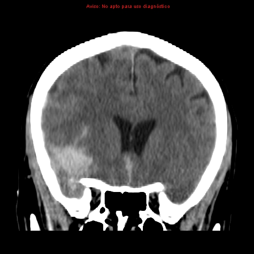 File:Aneurysmal subarachnoid hemorrhage (Radiopaedia 24740-24997 Coronal non-contrast 15).jpg
