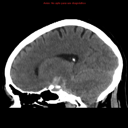 File:Aneurysmal subarachnoid hemorrhage (Radiopaedia 24740-24997 non-contrast 21).jpg