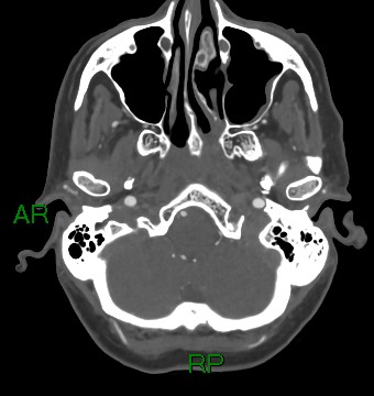 File:Aneurysmal subarachnoid hemorrhage with intra-axial extension (Radiopaedia 84371-99732 A 47).jpg