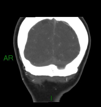 Aneurysmal subarachnoid hemorrhage with intra-axial extension (Radiopaedia 84371-99732 C 15).jpg