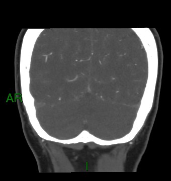 File:Aneurysmal subarachnoid hemorrhage with intra-axial extension (Radiopaedia 84371-99732 C 23).jpg