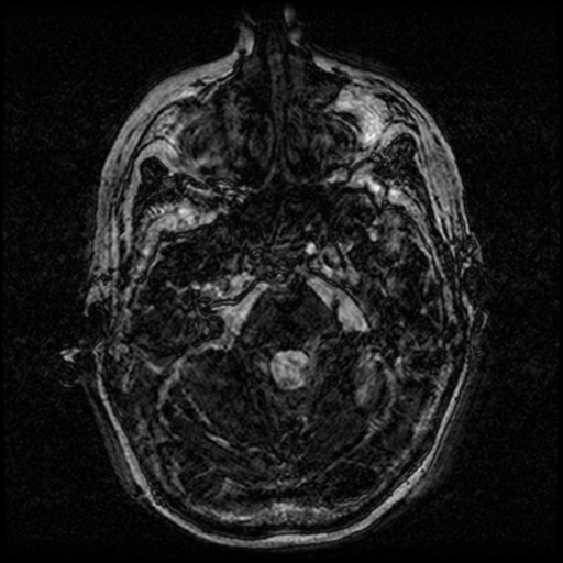Angioinvasive aspergillosis in the pituitary fossa (Radiopaedia 39676-42010 Ax 3D FIESTA VOLUME 25).png
