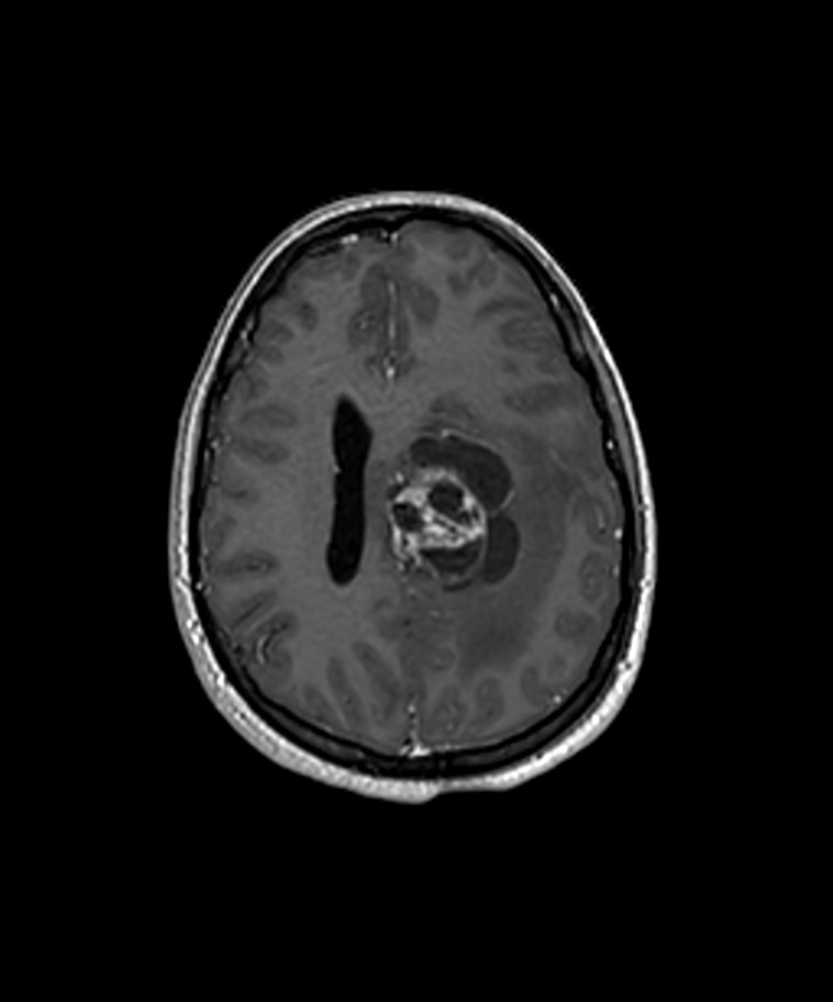 Angiomatous meningioma (Radiopaedia 79459-92577 Axial T1 C+ 3D ISO 23).jpg
