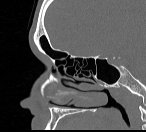 Angular epidermoid cyst (Radiopaedia 46908-51439 Sagittal bone window 33).png