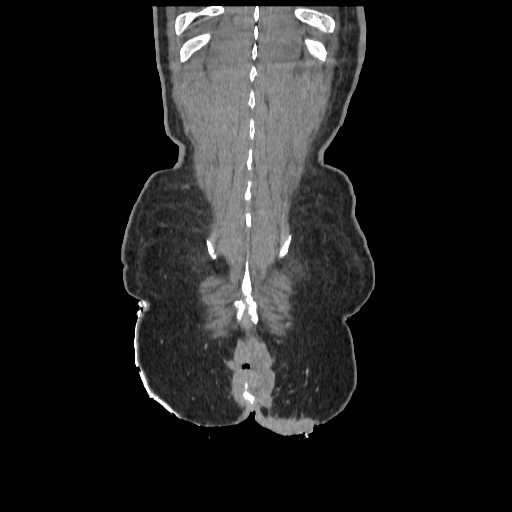 Anorectal carcinoma (Radiopaedia 44413-48064 B 86).jpg