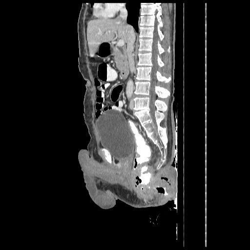 Anorectal carcinoma (Radiopaedia 44413-48064 C 51).jpg