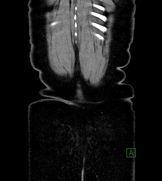 Anterior abdominal wall CSF pseudocyst (CSFoma) (Radiopaedia 79453-92571 B 53).jpg