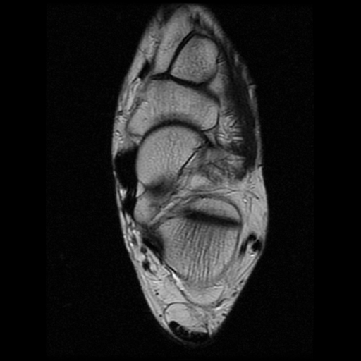 File:Anterior calcaneal process fracture (Radiopaedia 74654-85611 Axial T2 15).jpg