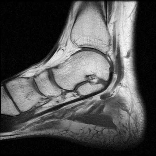 File:Anterior calcaneal process fracture (Radiopaedia 74654-85611 Sagittal T1 7).jpg