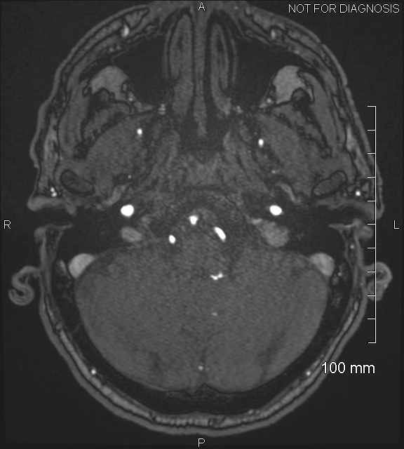 Anterior cerebral artery aneurysm (Radiopaedia 80683-94127 Axial MRA 38).jpg
