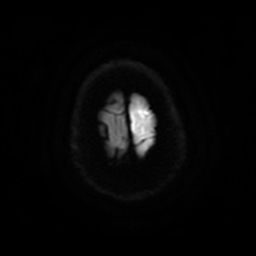 Anterior cerebral artery infarction (Radiopaedia 46794-51323 Axial DWI 27).jpg